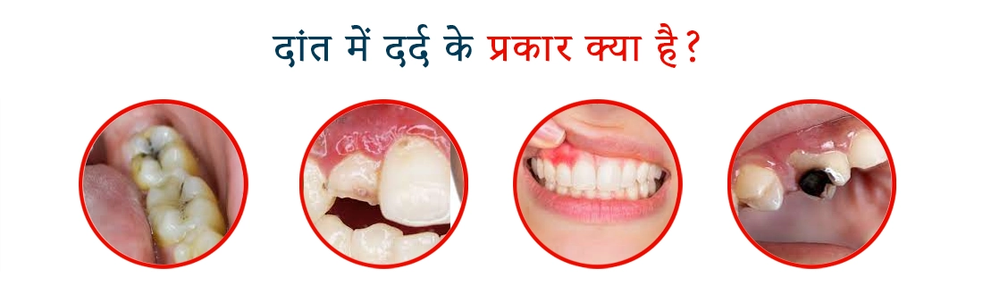 what are the types of toothache in hindi